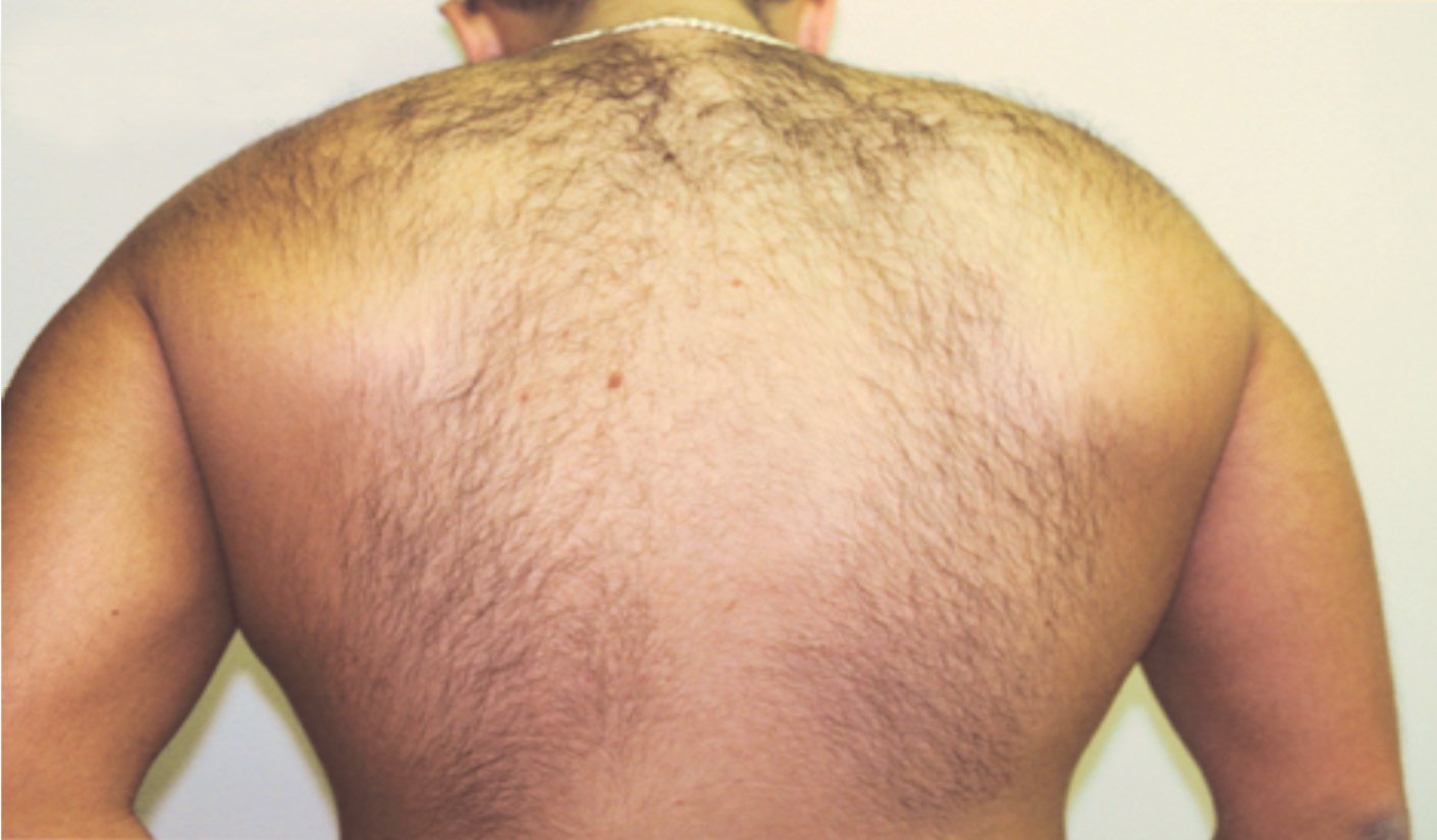 1GentleMax_Dr_Hutton_Before